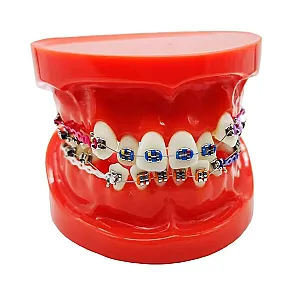 Modèle de démonstration orthodontique.