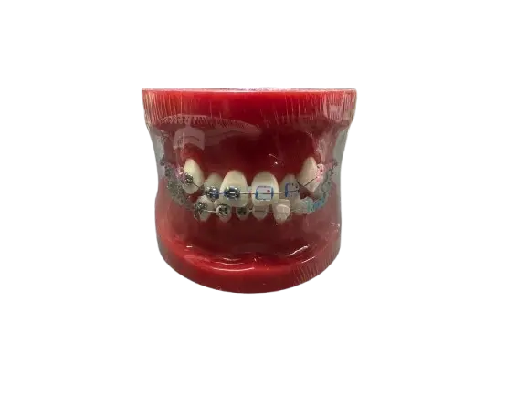 Modèle de démonstration orthodontique. alt